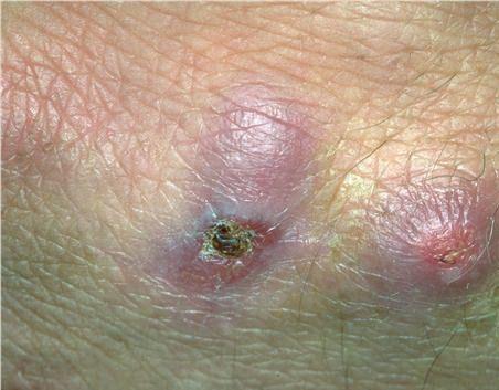 偶发分枝杆菌感染