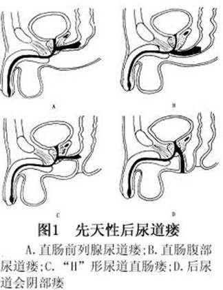 先天性直肠瘘图片