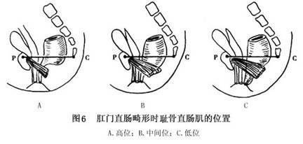 先天性肛門直腸畸形是怎麼回事