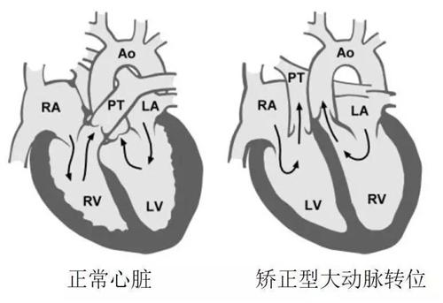 大动脉转位解剖图图片