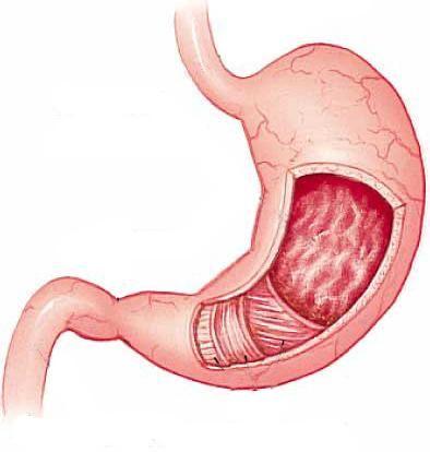 急性胃粘膜病变