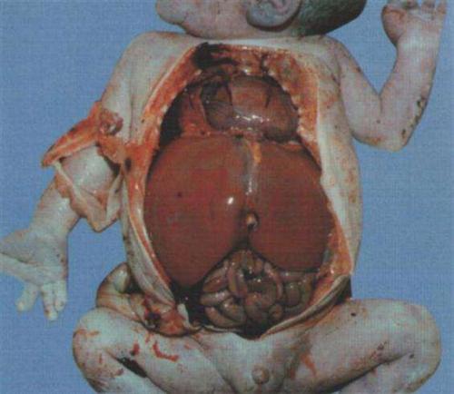 肝肿大的早期症状图片图片