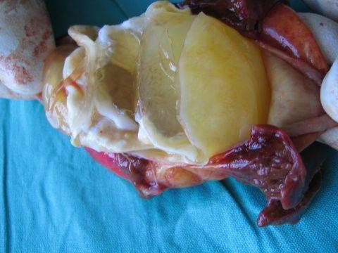 肝棘球蚴病理切片图片