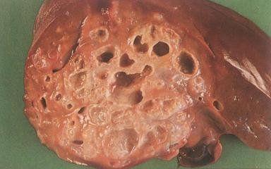 肝棘球蚴病理切片图片