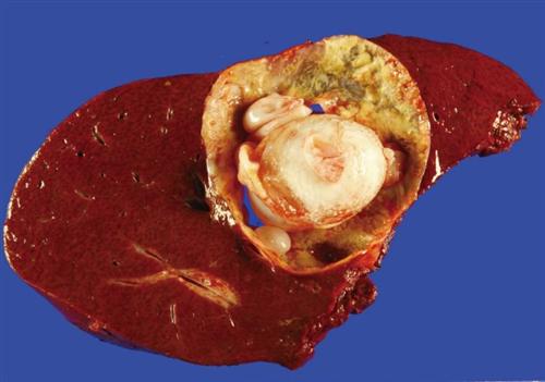 肝棘球蚴病理切片图片