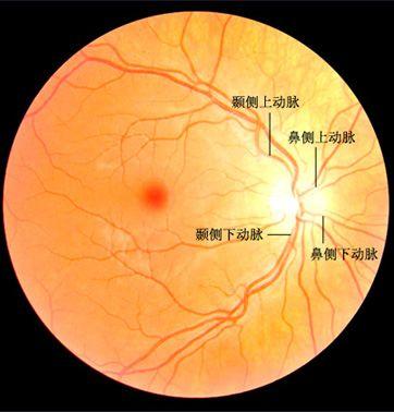 视网膜分支动脉阻塞