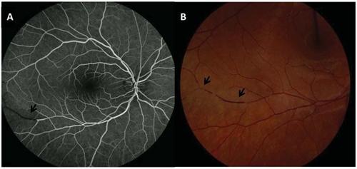 视网膜分支动脉阻塞