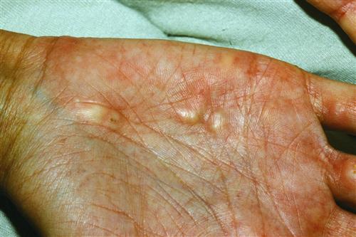 转移性皮肤钙化病