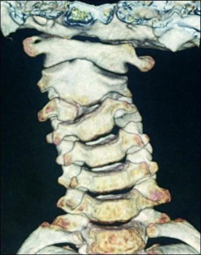 半椎体胎儿图片