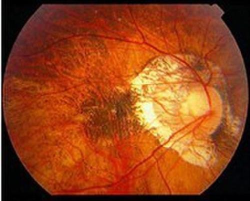 变性性近视的眼底损害
