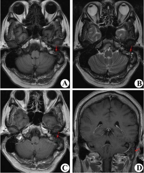头部乳突炎症图片图片