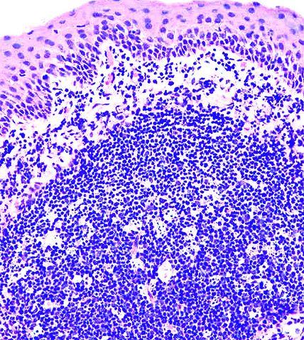 组织细胞增殖症