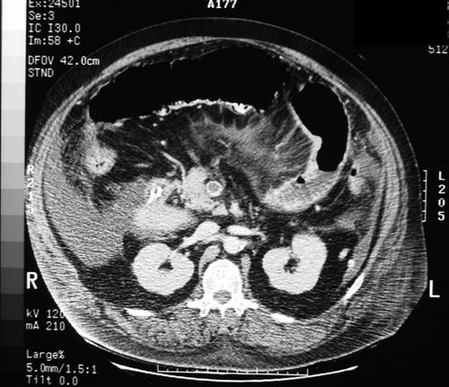 肠系膜上静脉血栓形成