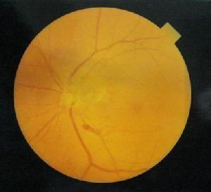 虹膜新生血管图片