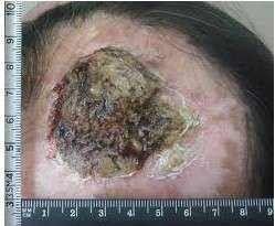 头部皮肤癌图片