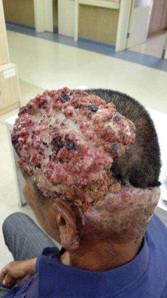 头皮基底细胞癌图片