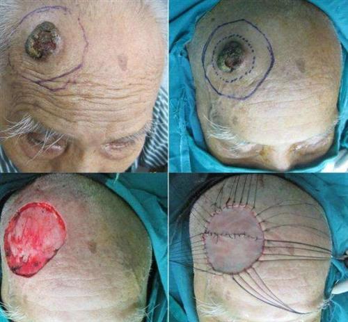 头皮鳞状细胞癌图片图片