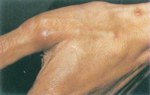 康诺尔立克次体斑疹热