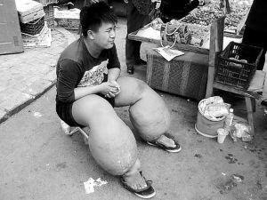 皮肤丝虫病能治好吗?