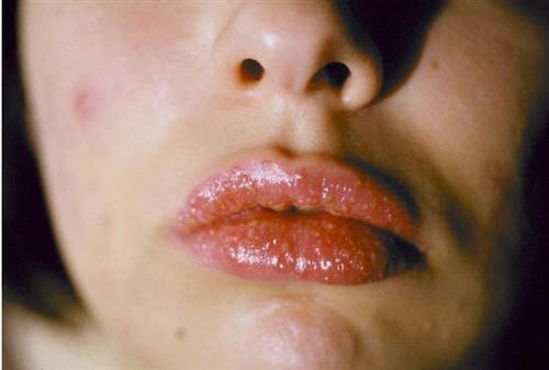 药物过敏性口炎