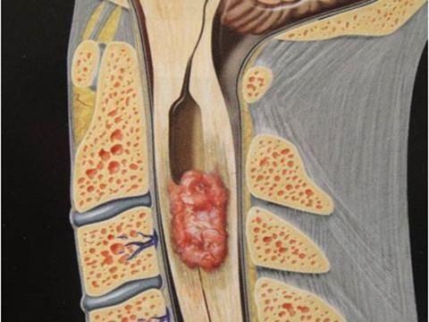 硬脊膜瘤图片