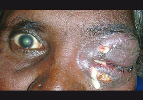 眼眶脓肿