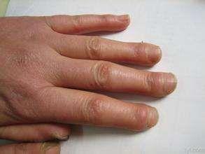 多发性肌炎皮肌炎