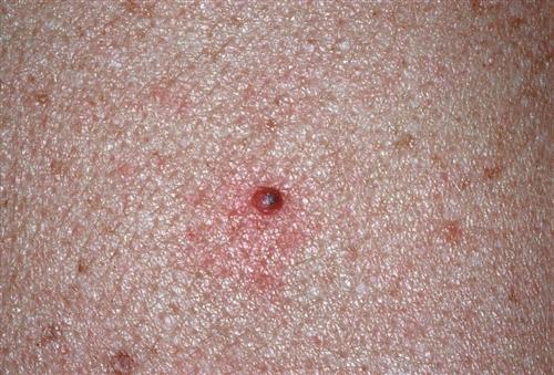 向医生提问恶性蓝痣别名:发病部位:并发疾病热门问答