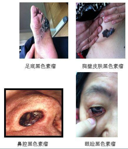 向医生提问恶性蓝痣别名:发病部位:并发疾病热门问答