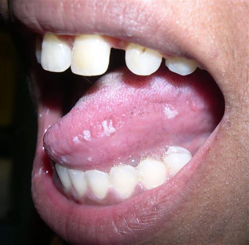 口腔白膜症状图片图片