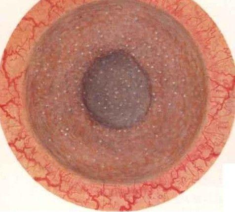 原发性急性闭角型青光眼