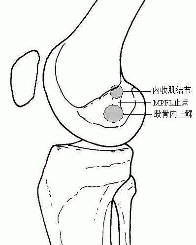 的治療複發性髕骨脫位保守治療方法複發性髕骨脫位手術後多久可以走路