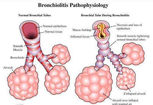 小儿毛细支气管炎