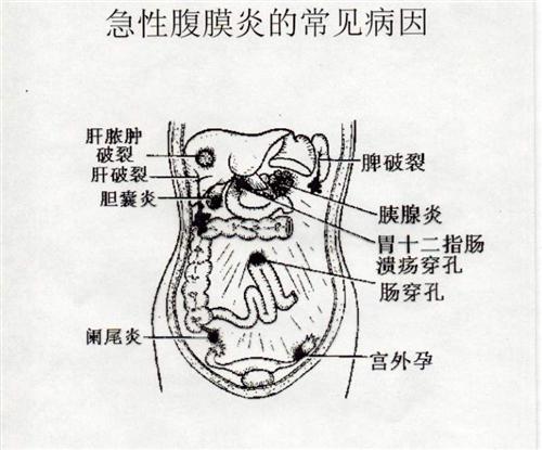 什么是急性弥漫性腹膜炎
