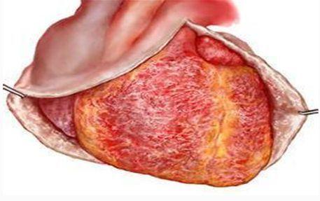 慢性缩窄性心包炎