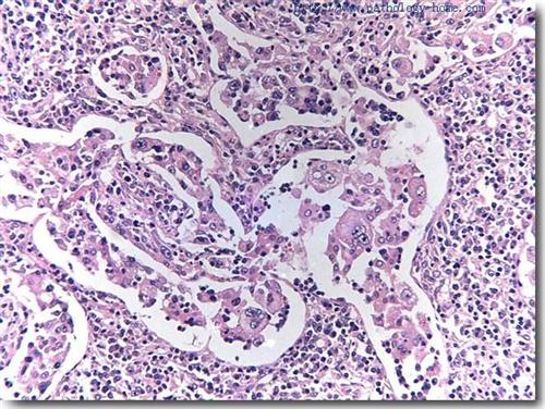 窦性组织细胞增生伴巨大淋巴结病