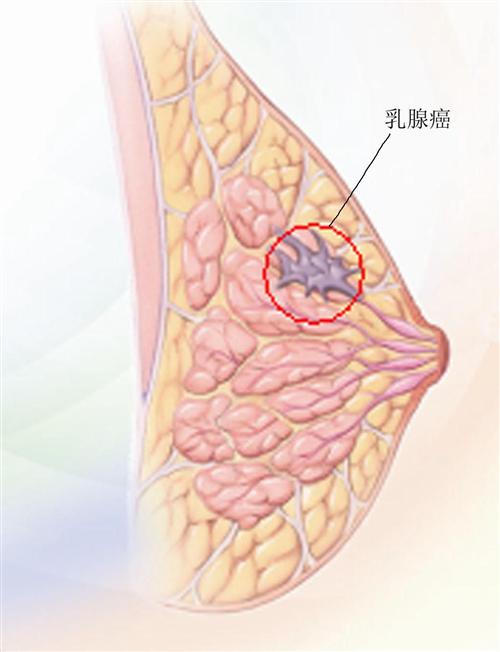 乳腺癌卫星结节图片图片