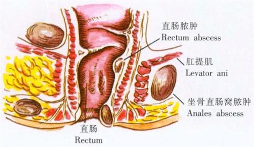 骨盆直肠间隙脓肿图片