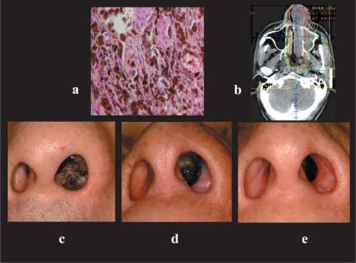 鼻腔癌图片图片