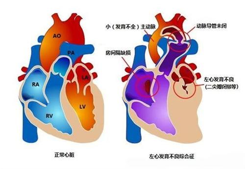 左心發育不良還能要嗎?