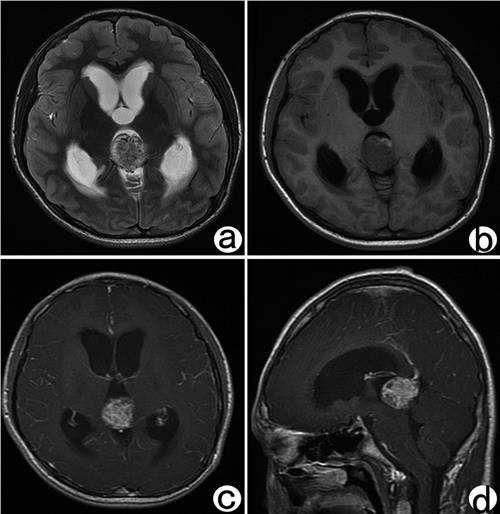 松果体细胞瘤图片