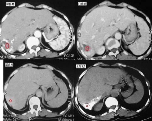 肝被膜紧张是什么