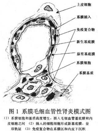 膜增生性肾小球肾炎怎么检查?