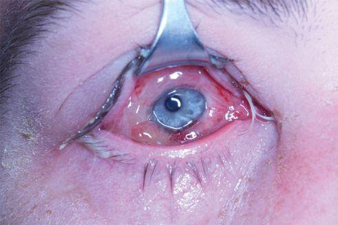 化脓性角膜炎用什么药