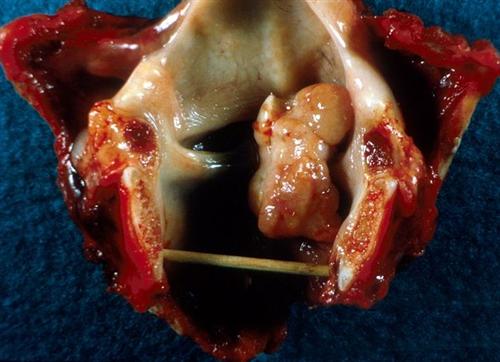 扁桃体纤维瘤形状图片图片