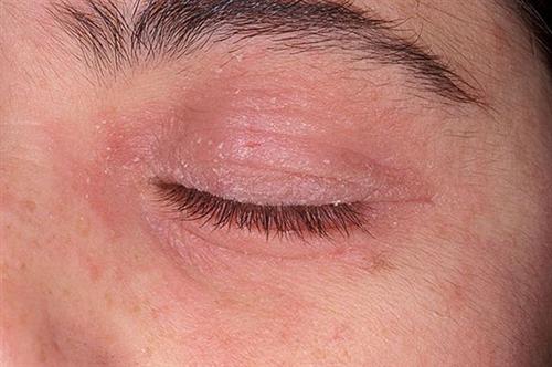 眼睑皮炎的症状图片图片
