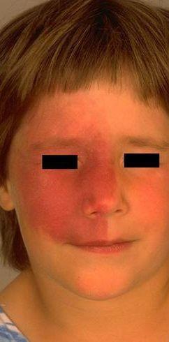 斯特奇韦伯综合征