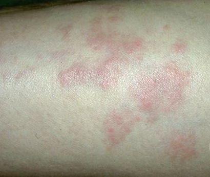 皮肤淋巴细胞浸润症