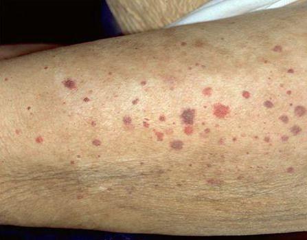 皮肤白细胞破碎性血管炎