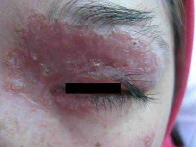 眼部梅毒初期症状图片图片